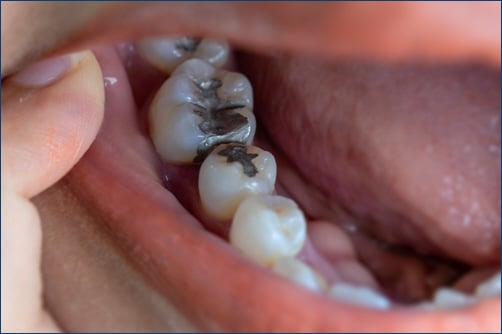 Ιστορική συμφωνία: Καταργούνται τα σφραγίσματα από υδράργυρο μέχρι το 2034