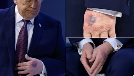 Ο μώλωπας στο χέρι Τραμπ που προκαλεί ψιθύρους - Η απάντηση που έδωσε (ΒΙΝΤΕΟ)