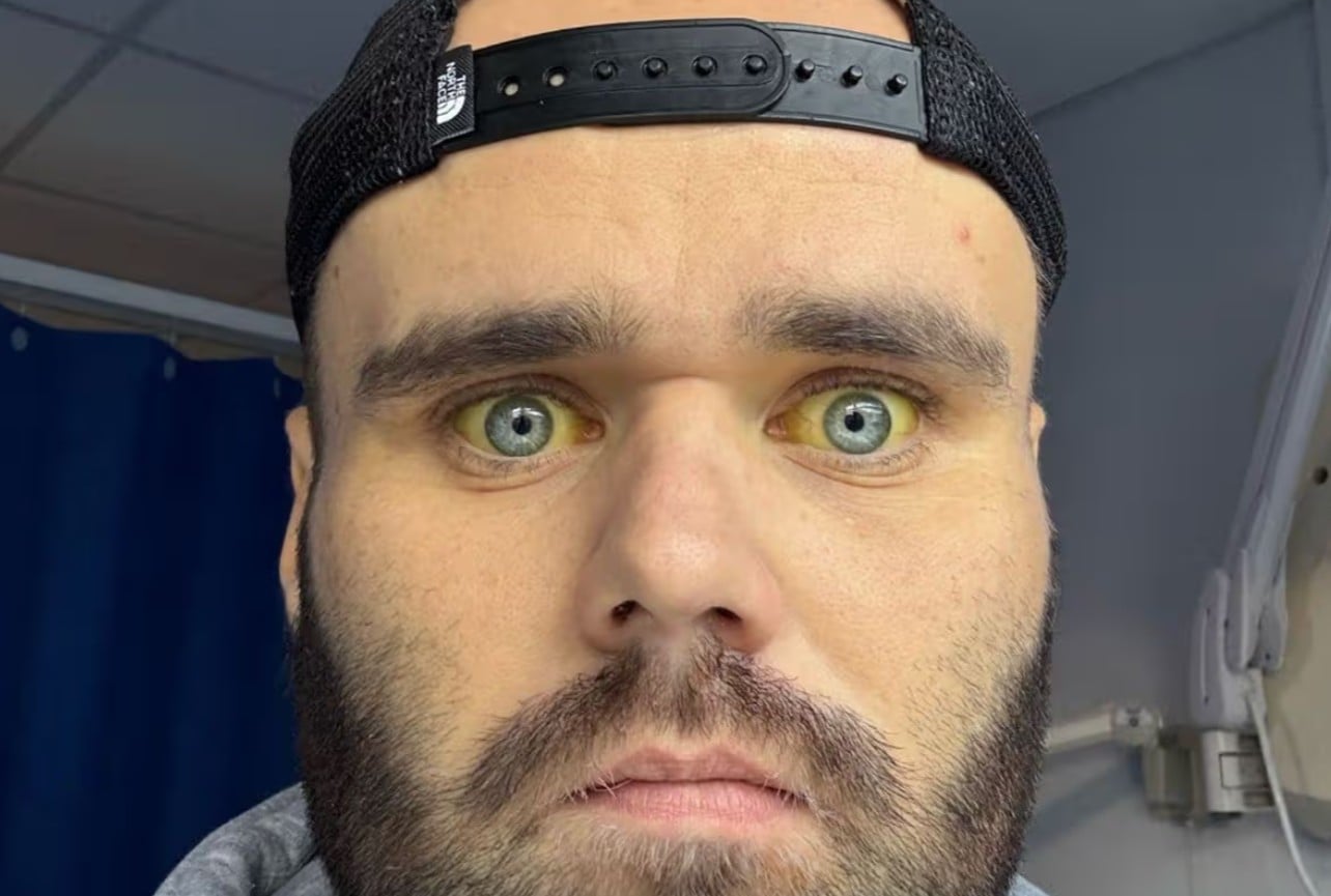 Man's Battle with Alcohol: From Yellow Eyes to Recovery