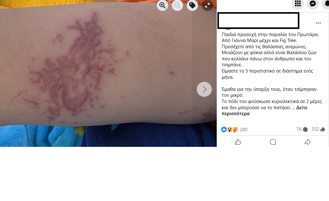 Αναφορές για τσιμπήματα ανεμώνων και μεδουσών - Τι λέει το ΤΑΘΕ